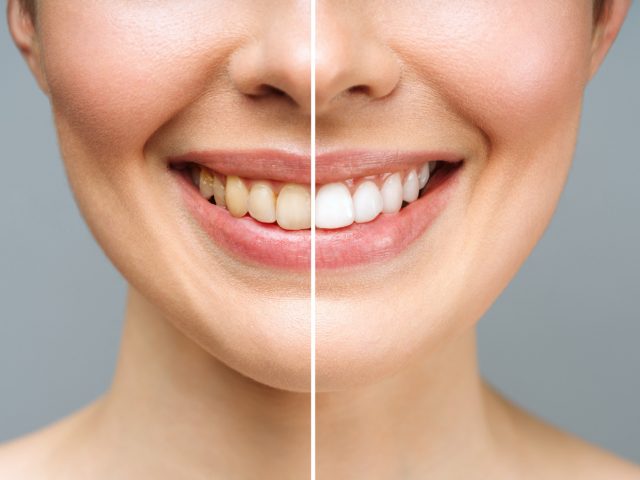 Clareamento Dental Antes e Depois