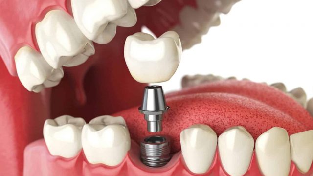 implante-dentario